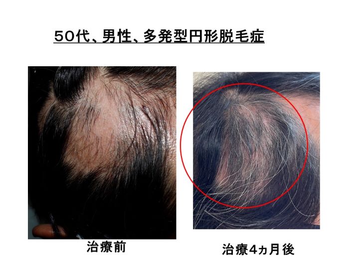 円形脱毛症　病院